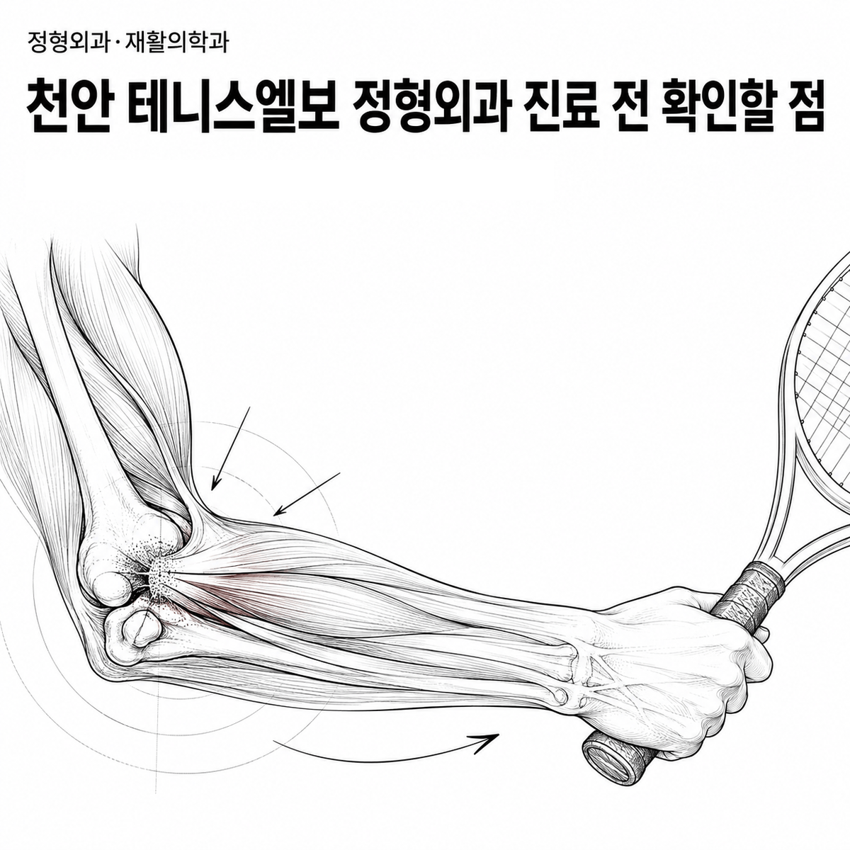 천안 테니스엘보 정형외과 진료 전 확인할 점 핵심 정보 이미지